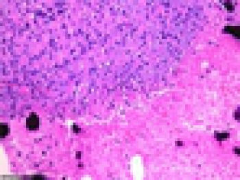 Опухоль собаки после лечения бактериями. Светло-розовые области  некроз опухоли, следующий в районы с жизнеспособных опухолевых клеток. Чёрные пятна  кальцинированная область ткани